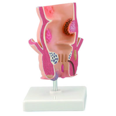 Pathological Model Of The Rectum
